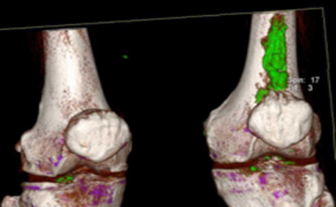 双源CT显示膝关节尿酸盐晶